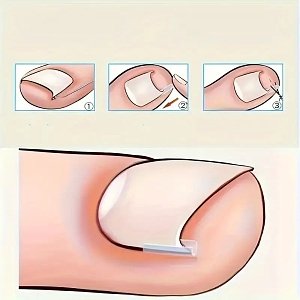 Ingrown Toenail Correction Strips Nail Edge Support 20pcs