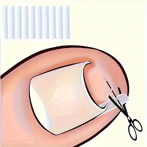Ingrown Toenail Correction Strips Nail Edge Support 20pcs